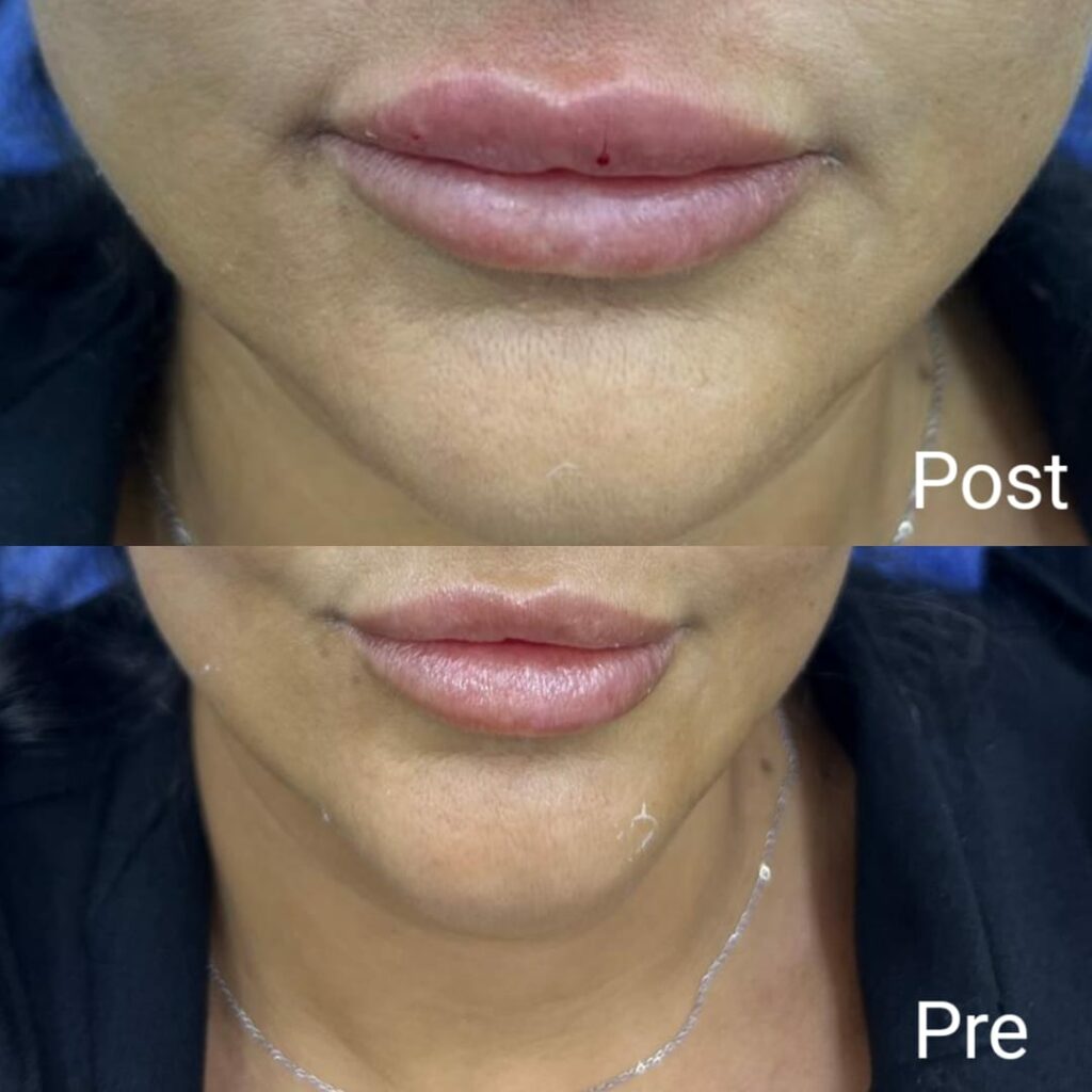 Lip lift session before and after